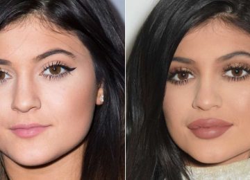 5 Fakta Lip Filler yang Buat Bibirmu Lebih WOW