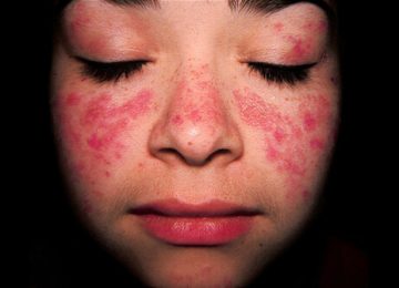 8 Fakta Tentang Penyakit Lupus yang Harus Kamu Tau