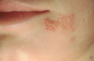 5 Cara Jitu Atasi Herpes