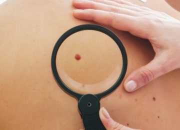 Tahi Lalat Tanda Kanker Kulit? Cek Faktanya di Sini!