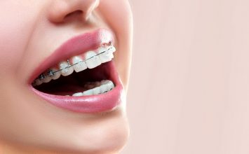 Amankah Menggunakan Behel bagi Ibu Hamil?