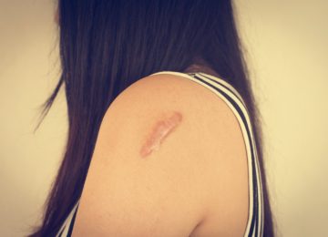 Mengenal Keloid, Ketika Luka Ngga Sembuh Sempurna