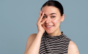 Melasma vs Flek Hitam, Apa Bedanya?   