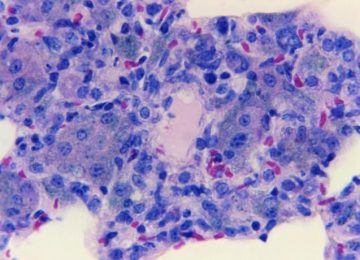 Mycobacterium bovis, Penyebab TBC via Makanan
