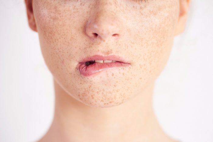 cegah dan kendalikan melasma