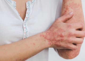 Diet yang Tepat Bagi Penderita Psoriasis