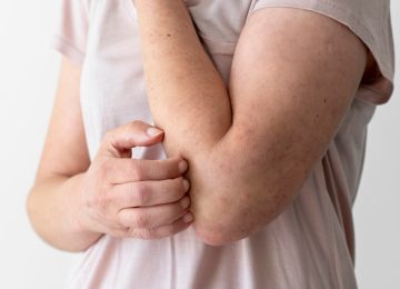 Waspadai Penyakit Systemic Lupus Erythematosus (SLE)