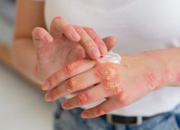 Family: Tema Hari Psoriasis Sedunia 2024 yang Penuh Makna